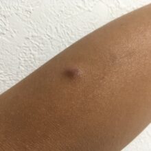 季節の変わり目に急増？粉瘤の腫れと化膿にご注意を！